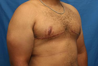 After Results for Gynecomastia