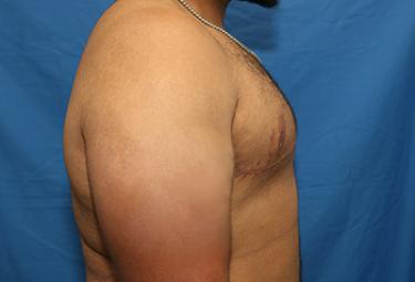 After Results for Gynecomastia