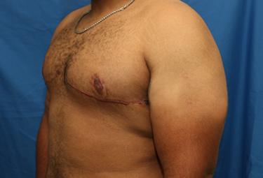 After Results for Gynecomastia