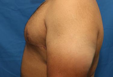 After Results for Gynecomastia