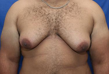 Before Results for Gynecomastia