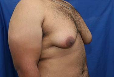 Before Results for Gynecomastia