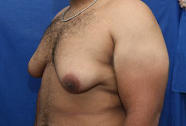 Before Results for Gynecomastia