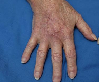 After Results for Wound Care, Hand Surgery
