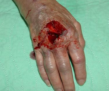 Before Results for Wound Care, Hand Surgery