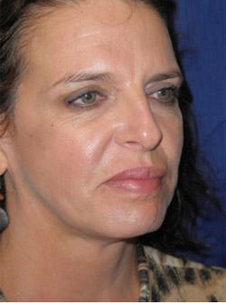 After Results for Facelift