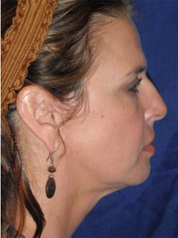 After Results for Facelift