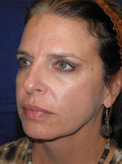 After Results for Facelift