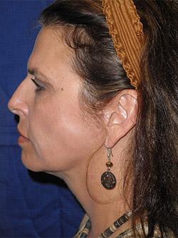 After Results for Neck Lift