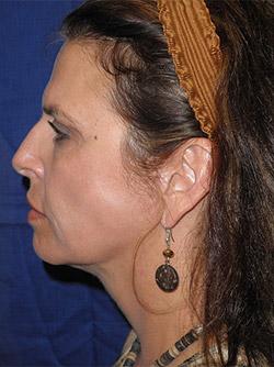 After Results for Facelift