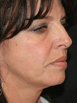 Before Results for Facelift, Neck Lift