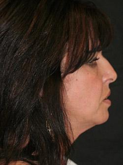 Before Results for Facelift