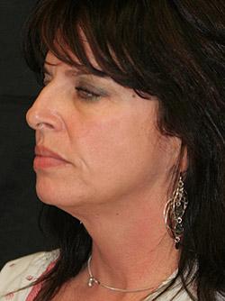 Before Results for Facelift