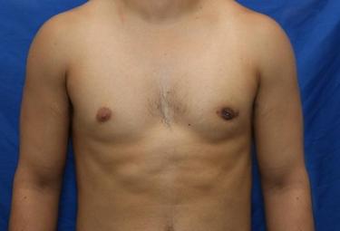 After Results for Gynecomastia