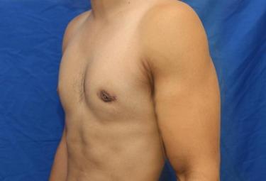 After Results for Gynecomastia