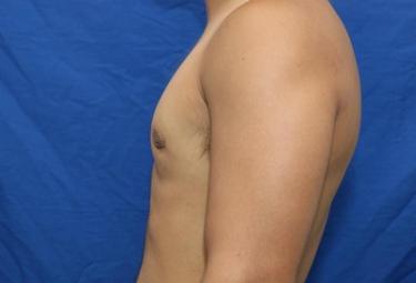 After Results for Gynecomastia