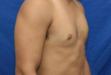 After Results for Gynecomastia