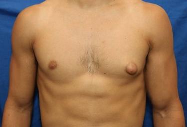 Before Results for Gynecomastia