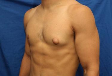 Before Results for Gynecomastia