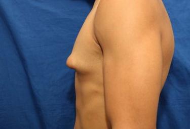 Before Results for Gynecomastia