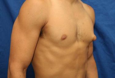 Before Results for Gynecomastia