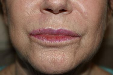 After Results for Tissue Fillers, Lip Augmentation