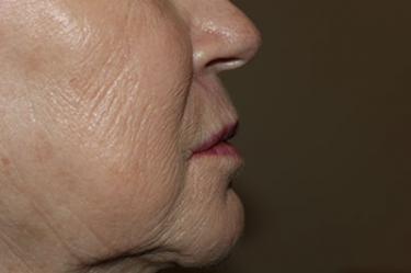 After Results for Tissue Fillers, Lip Augmentation