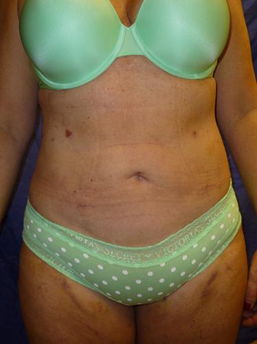 After Results for Liposuction