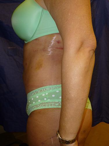 After Results for Liposuction