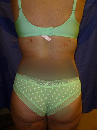 After Results for Liposuction