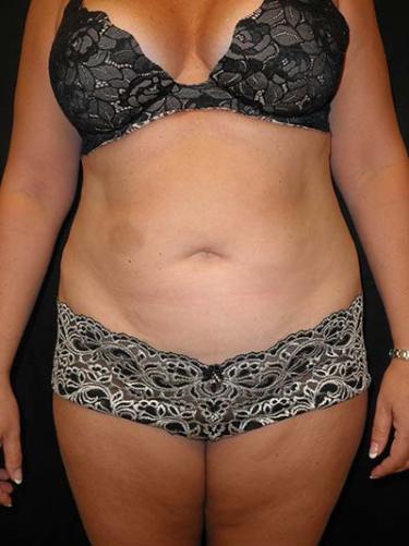 Before Results for Liposuction