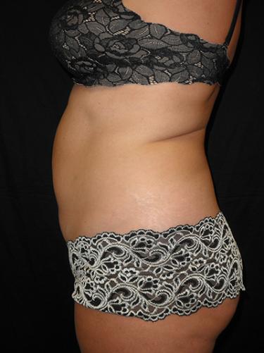 Before Results for Liposuction