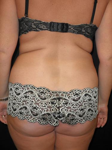 Before Results for Liposuction