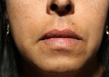 After Results for Tissue Fillers, Lip Augmentation