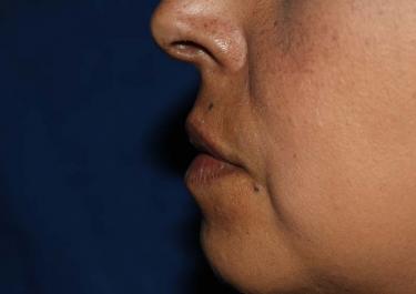 After Results for Lip Augmentation
