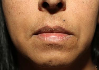 Before Results for Tissue Fillers, Lip Augmentation