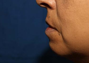 Before Results for Tissue Fillers, Lip Augmentation