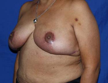 After Results for Breast Reduction