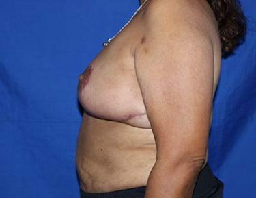 After Results for Breast Reduction