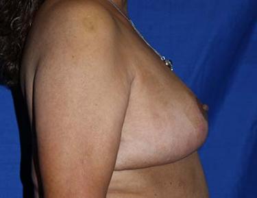 After Results for Breast Reduction