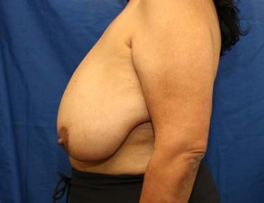 Before Results for Breast Reduction