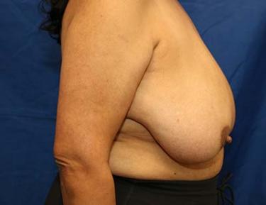 Before Results for Breast Reduction