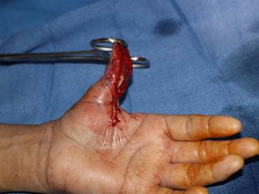 Before Results for Hand Surgery