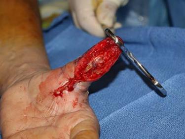 Before Results for Hand Surgery