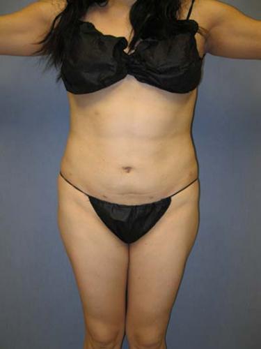 After Results for Liposuction