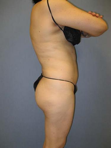 After Results for Liposuction