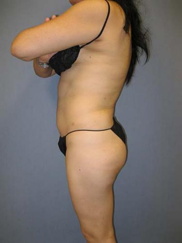 After Results for Liposuction