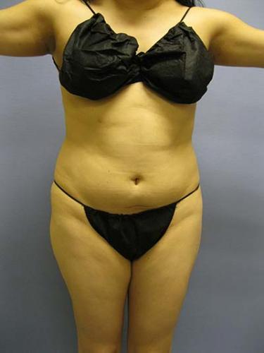 Before Results for Liposuction