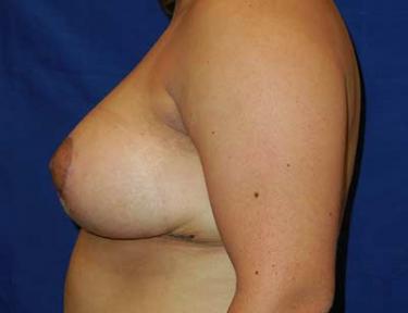 After Results for Breast Reduction