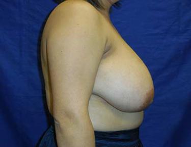 Before Results for Breast Reduction